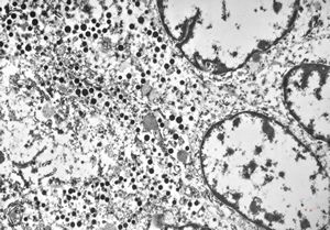 F,73y. | mixed mucinous and endocrine carcinoma